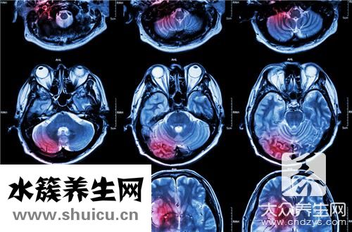急性脑出血