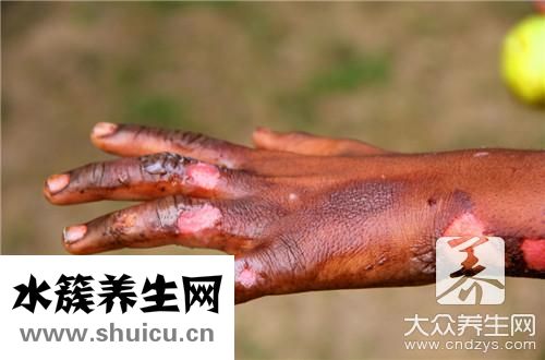 伤口会痒