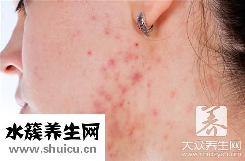 起痘痘位置对照内脏