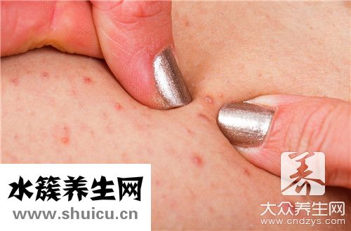 毛囊炎用什么药膏