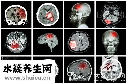 血管支架手术