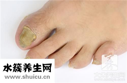 我灰指甲自愈了