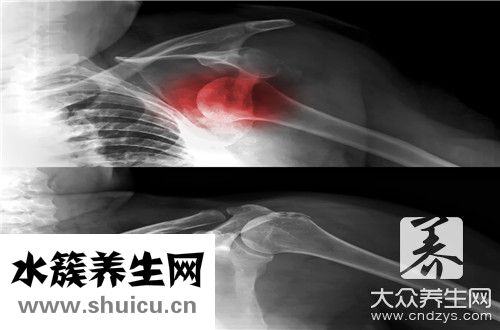 尺桡骨骨折