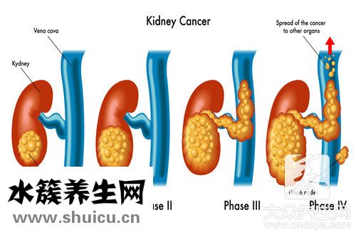 慢性肾脏病3期