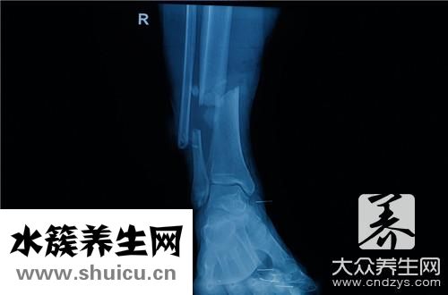 胫骨痛