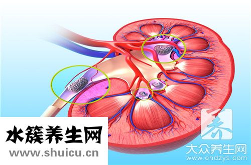 肾结石是什么引起
