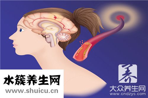 大脑血管痉挛怎么治疗？脑血管痉挛怎么治疗