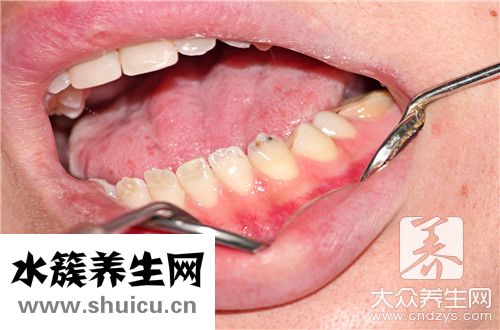 拔牙后发烧