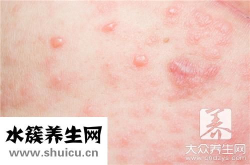 全身痒是回事挠了还起红疙瘩
