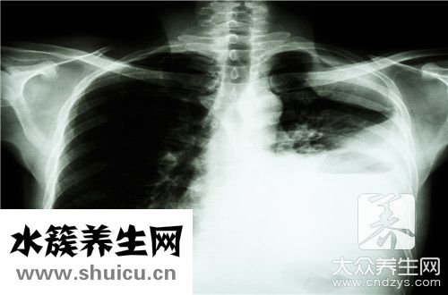 肺部钙化灶