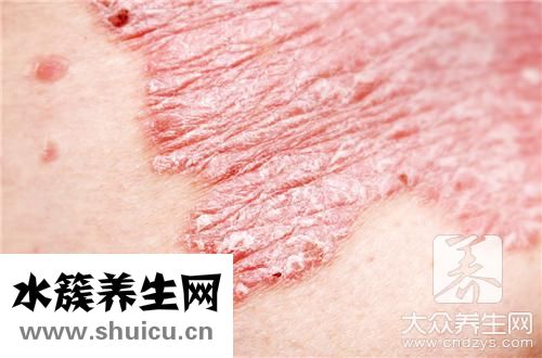 癣治疗