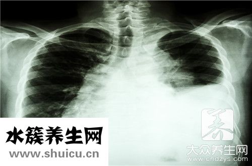 包裹性积液
