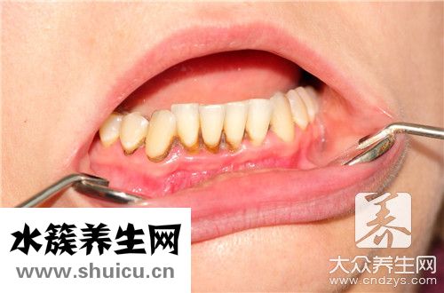 牙龈出血不止