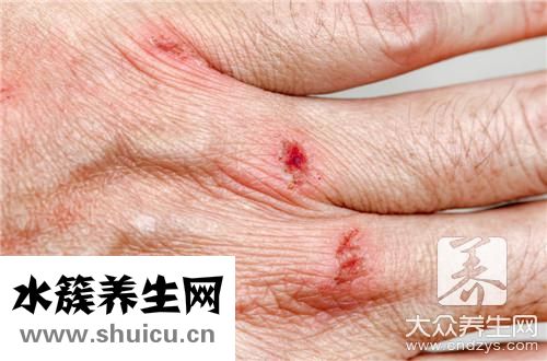 白色疤痕