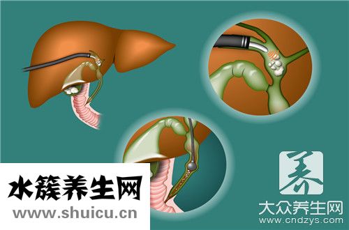 排出结石