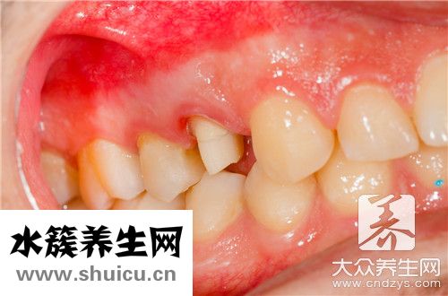 牙龈出血不止