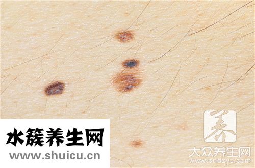 痦子是什么