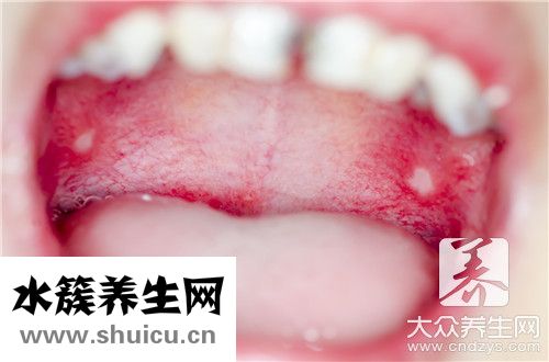 口腔霉菌感染