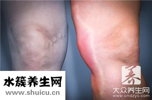 消除水肿最快方法