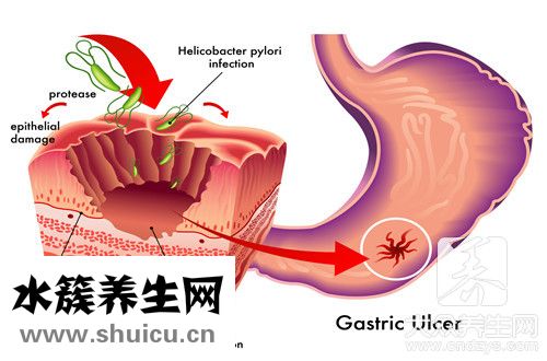 浅表性胃炎伴胆汁反流