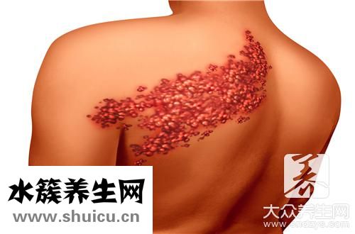 带状疱疹最快治疗方法