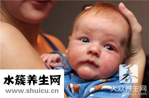 长湿疹是身体排毒表现