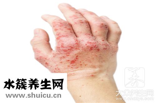 长湿疹是身体排毒表现