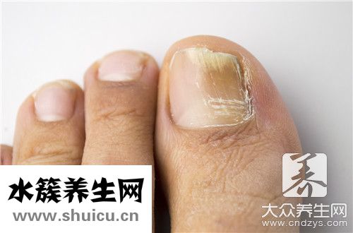 指甲都是密密麻麻小坑