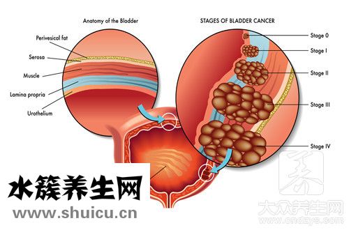导管内癌