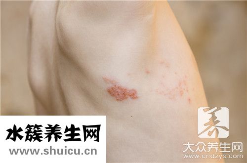 疱疹治疗法
