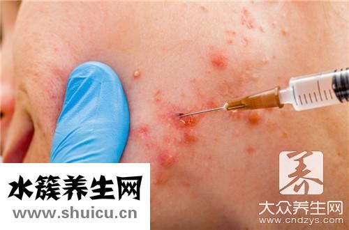 挤痘引发脑膜炎