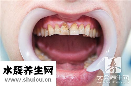 牙齿有黑垢办