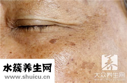 尖锐疣会自己消失