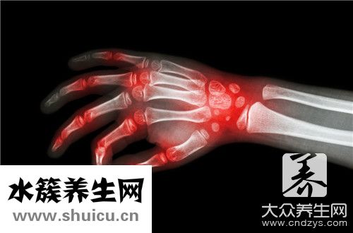 痛风脚肿消肿