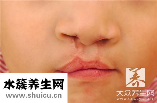嘴唇干裂快速恢复