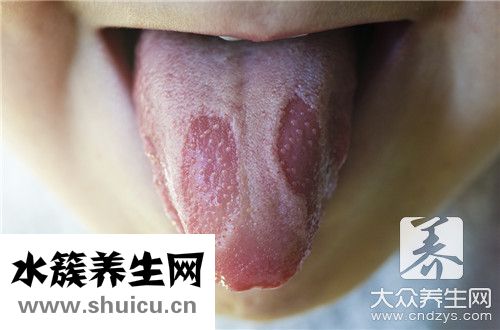 舌头两侧溃疡