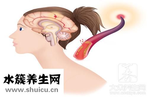 脑疝存活率