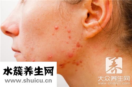 玫瑰痤疮治疗方法