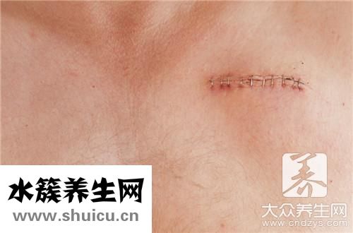 伤口愈合过程
