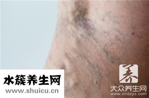 静脉血管曲张