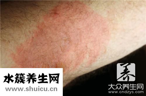 紫癜会痒吗