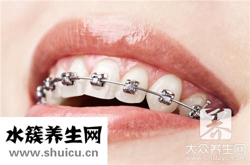 隐形牙齿正畸