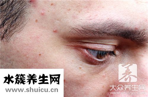 水痘坑能抚平吗，最有效的修复方法