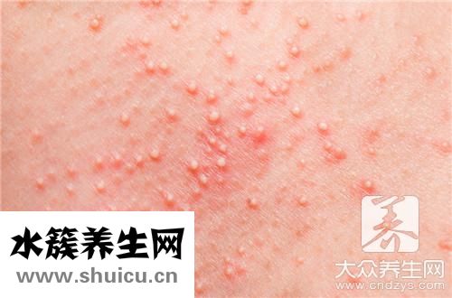 身上长大红疙瘩硬硬