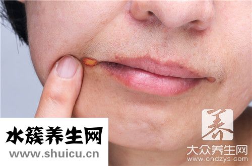 龈颊沟