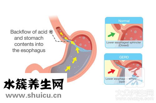 反流食道炎