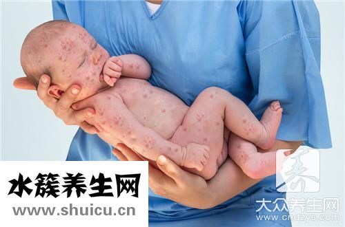 屁股沟湿疹