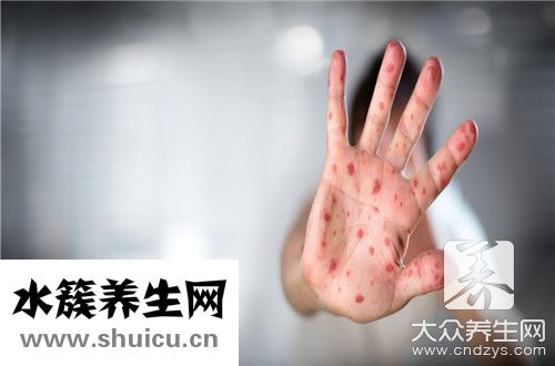 手部湿疹和手癣区别