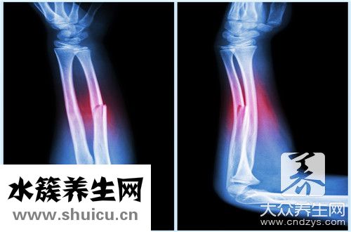 骨折过早走路危害