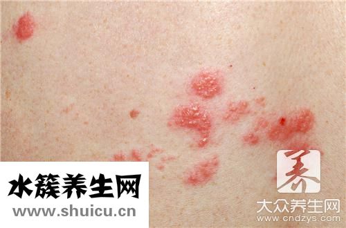 湿疹脱皮